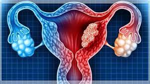 Clicca per accedere all'articolo “PERCORSO DIAGNOSTICO E TERAPEUTICO NELLE PAZIENTI AFFETTA DA TUMORE DELL'OVAIO”